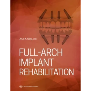 Full-Arch Implant Rehabilitation