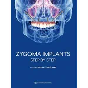 Zygoma Implants: Step by Step